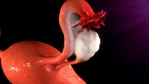A close-up of an ovarian cyst on a fallopian tube