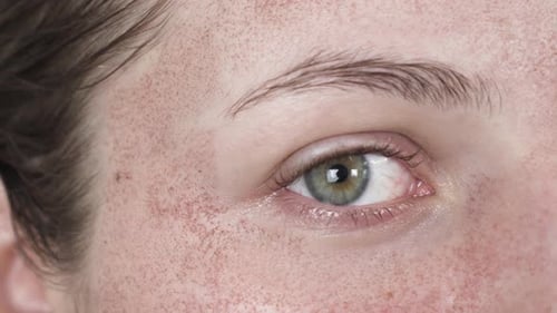 Close Up Woman with Green Eyes Co2 Laser Treatment Scars Face After Procedure