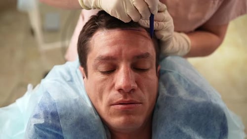 Top View of Trichologist Marking Hair Line to Balding Male Patient with Hairloss Problem Point of