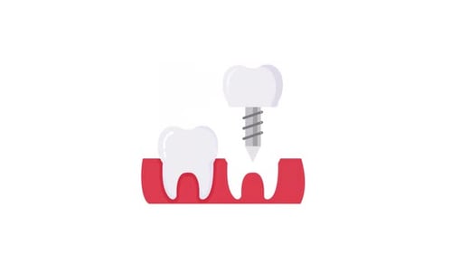 Animated Flat Design Dental Implant Installation Process