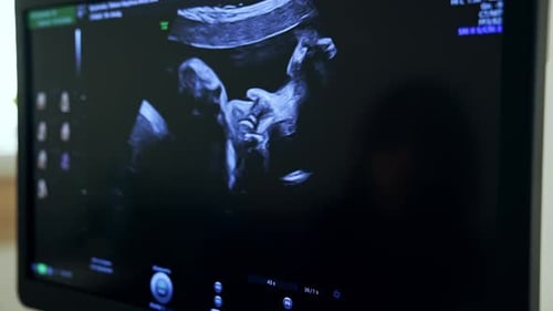 Ultrasonic picture of a baby in mom's womb at the black screen.
