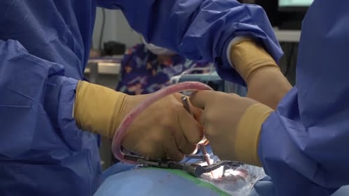Chirurgie de la colonne vertébrale ou cages intercorporelles pour la fusion de la colonne vertébrale
