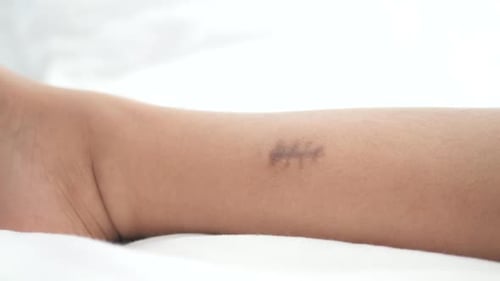 Stitched Wound Mark on a Child Foot