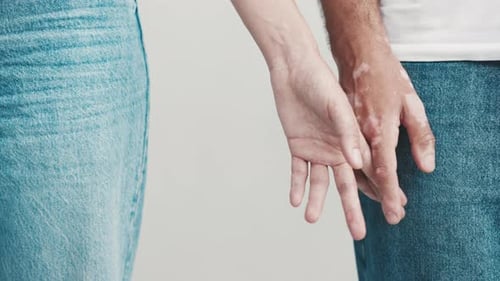 Couple Holding Hands with Vitiligo Close Up