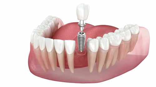 3D Animation of Dental Implant Installation Process