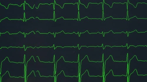 Medical Electrocardiogram Displaying Heart Rhythm