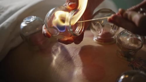 Cupping Therapy Treatment for Relaxation and Wellness