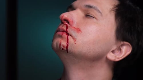 Man Suffering Nosebleed with Blood Dripping on Chin