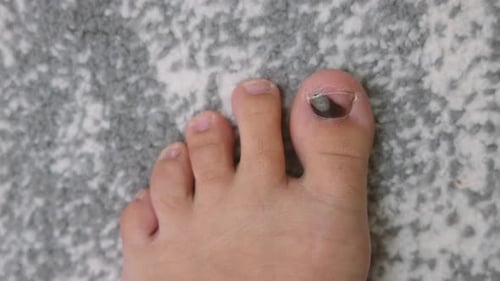 Foot with Bruised Toenail, Close Up