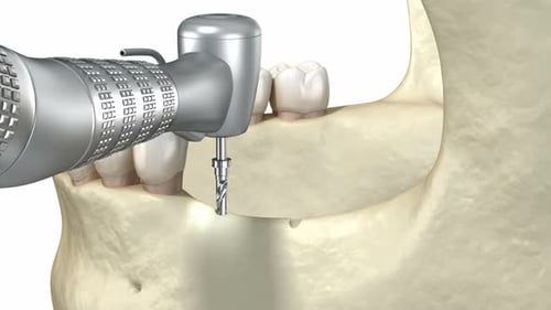 Cleavage of the alveolar ridge, augmentation, implantation. Dental surgery, 3D animation.