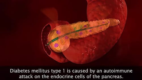 Type 1 Diabetes Mellitus: Autoimmune Attack on Pancreatic Cells 3D Animation