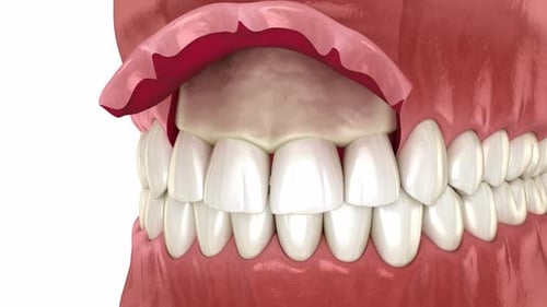 Frontal crown lengthening, Esthetic surgery