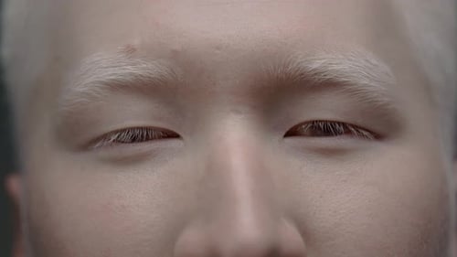 Close Up Portrait of the Eye of an Asian Albino Guy Looking Into the Camera A Genetic Mutation of