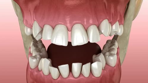 Human Jaw Anatomy and Malocclusion 3D Animation