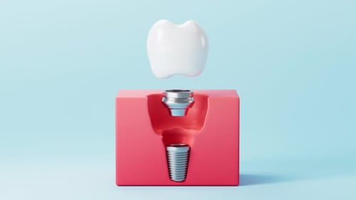 Dental implant surgery process. A concept of implantation teeth and dental surgery. 3d rendering.