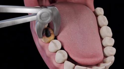 Realistic 3D Animation of Tooth Extraction and Suturing Process