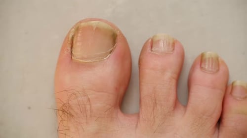 Close Up of a Foot with Onychomycosis Toenail Fungus