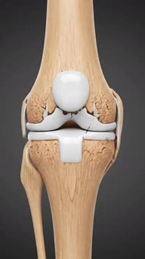 Osteoarthritis - Progressive Cartilage Loss 3D Medical Animation | Manestream Den
