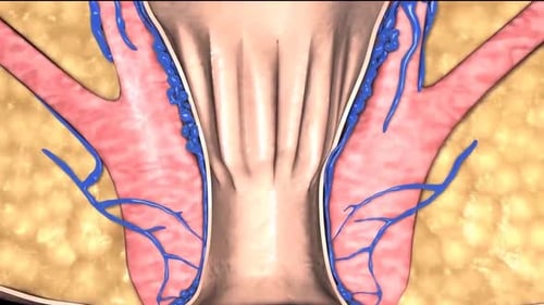 Hemorrhoid Formation Animation: Medical 3D Anatomy