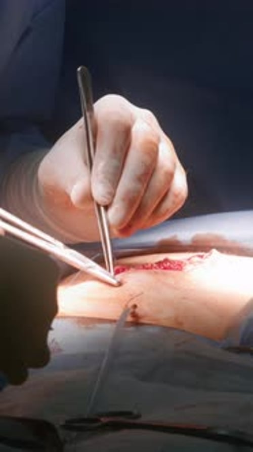 Professional Surgeon Stitches Cut Using Medical Clip and Tweezers