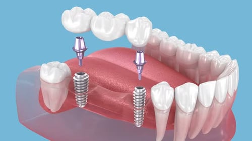 Dental bridge based on two implants. Medically accurate 3D Animation of human teeth and dentures con