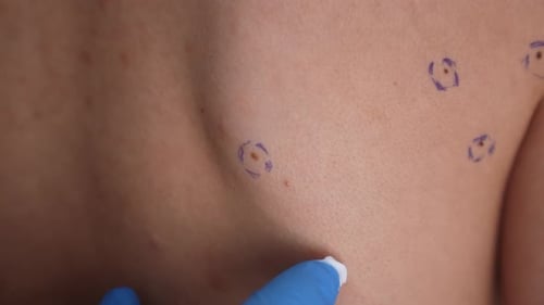 Ein Arzt trägt Schutzcreme auf einen Maulwurf am Körper eines Mannes auf