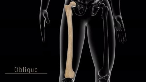 Medical animation showing different types of human femur bone fractures