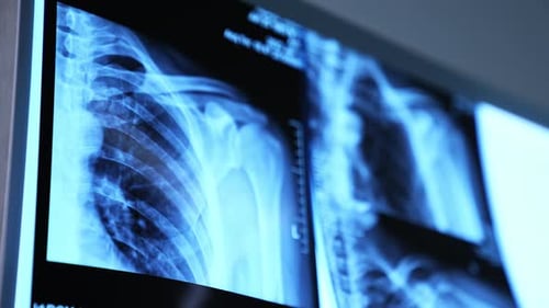Chest and Shoulder X-Ray Scans on Display Screen