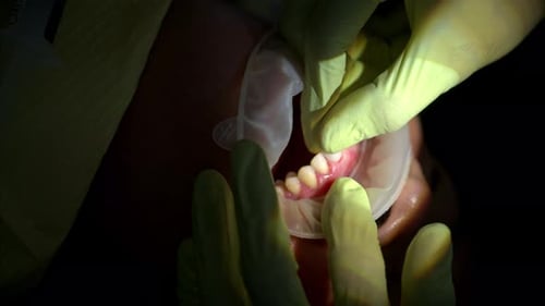 Slow motion vertical shot of a dentist wearing green latex gloves placing a ceramic composite veneer