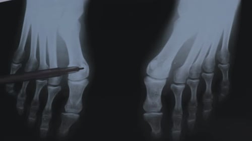 Arthrose