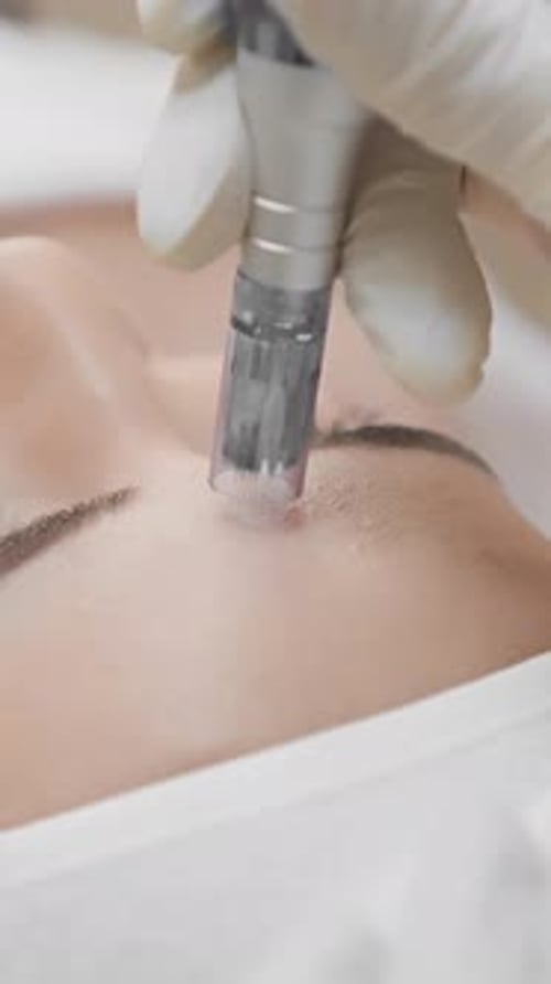 Microneedling performed in a beauticians clinic focuses on skin rejuvenation