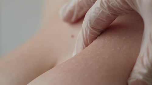 Nahaufnahme der dermatologischen Untersuchung eines Patienten mit blasenbildendem Hautausschlag