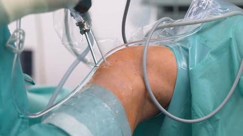 Surgeon Performing Arthroscopic Knee Surgery - close-up. Doctor Using Viewing Scope