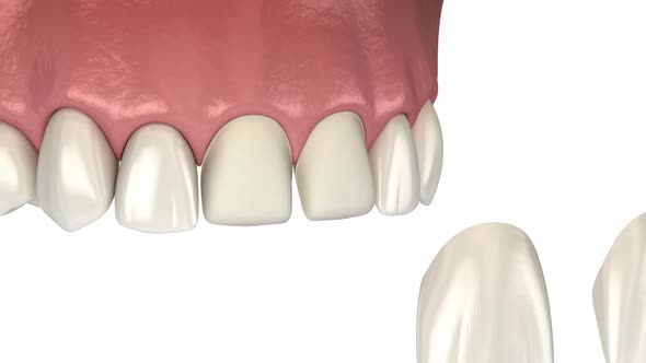 Veneers - preparation, mockup, color choosing and placement of dental ...