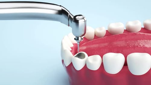 3D Dental Crown Installation Process Animation
