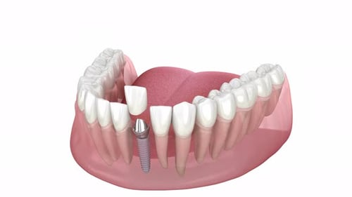 3D Animation of Dental Implant Installation in Human Jaw
