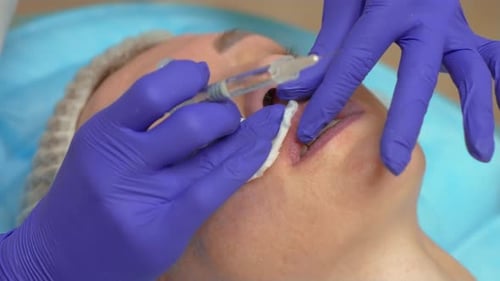 Inyecciones de relleno de aumento de labios en una clínica de cosmetología estética