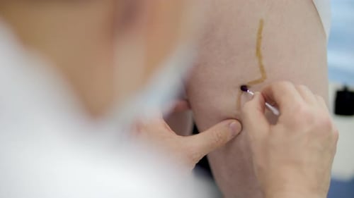 Doctor Marking Vein on Patient Leg Before Surgery