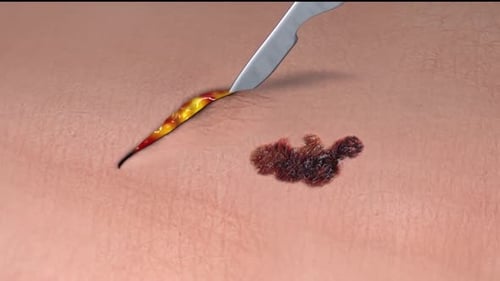Close-up of mole removal with medical tool on human skin