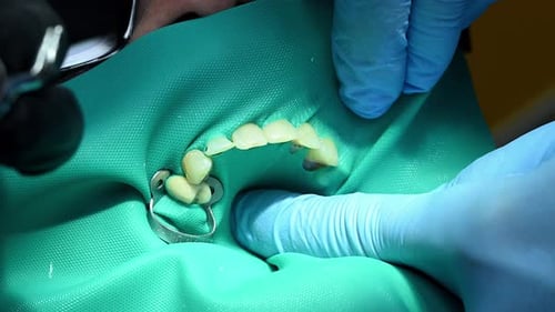 Dental Extreme Close Up Macro Video Dentist Treat Patient Teeth Orthodontist Works with an Assistant