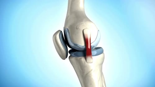 Human Knee Joint Anatomy with Ligament Injury Animation