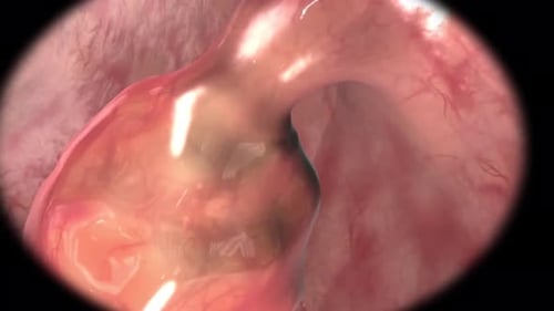 Detailed 3D medical animation of colon polyp