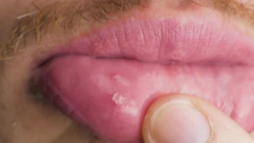 an aphtha oral inflammation on the gums CLOSE UP