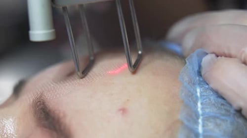Beautician Cosmetologist Doing Procedure Fractional Microneedle Mesotherapy Rejuvenation with Laser