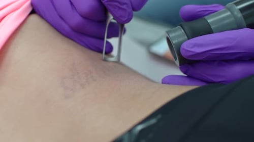 Girl erasing tattoo of exboyfriend name, deleting or removing. Dermatologist clinic tatto erase