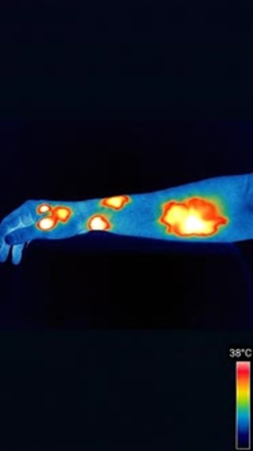 Psoriasis - Skin Inflammation Thermal Heat Map 3D Animation | Manestream Den