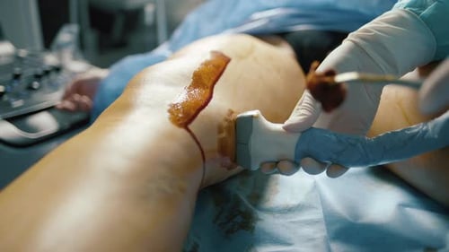 Surgeon performing vein surgery on patient in hospital operating room