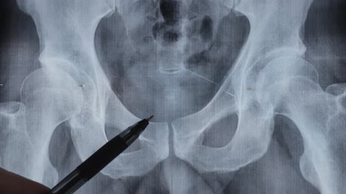 Diagnóstico de la enfermedad de la columna vertebral, la articulación de la cadera y la hernia intervertebral.