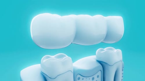 Conceptual 3D animation of a dental bridge