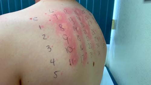 Allergy skin test on teen boy's back with inflammed allergic reactions, medical doctor's office, 4k